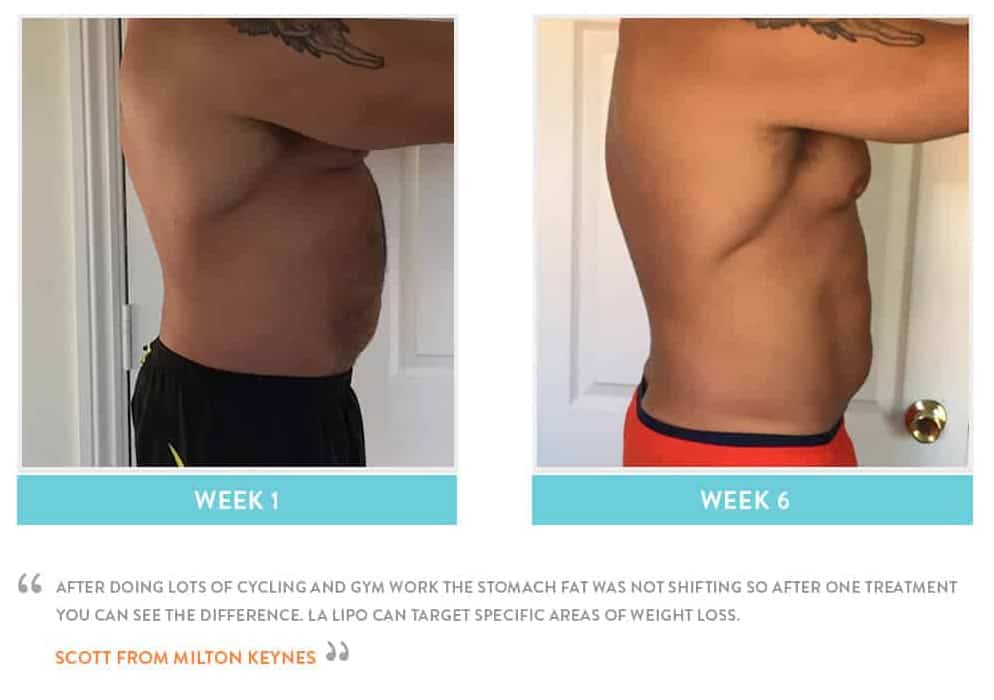 Before & After Stomach Fat Ruislip