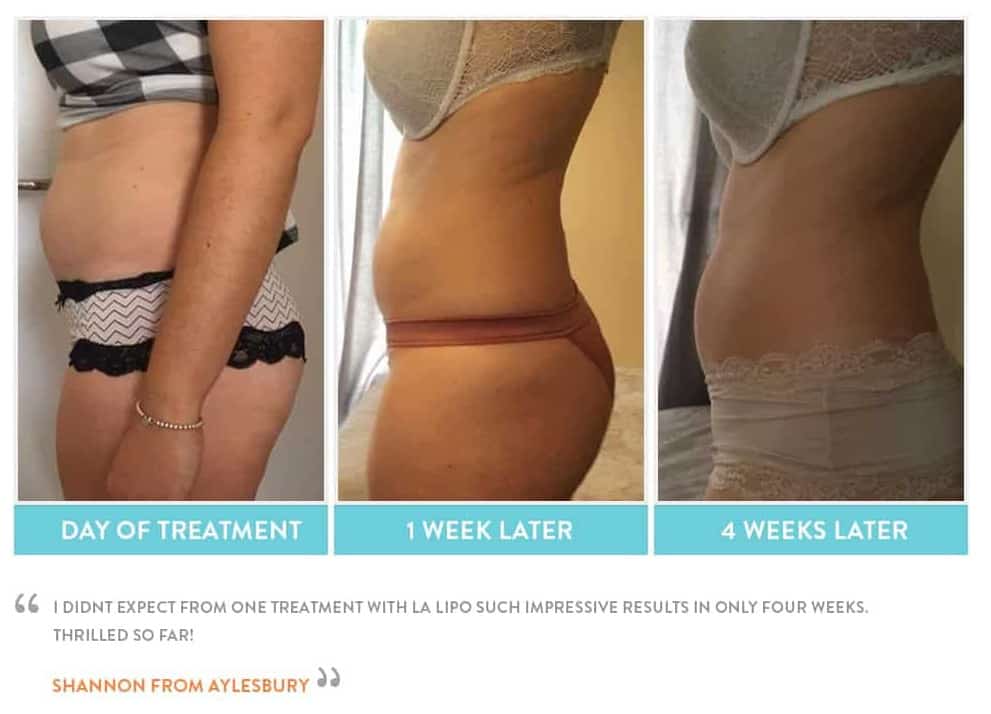 before, Cryolipolysis Ruislip