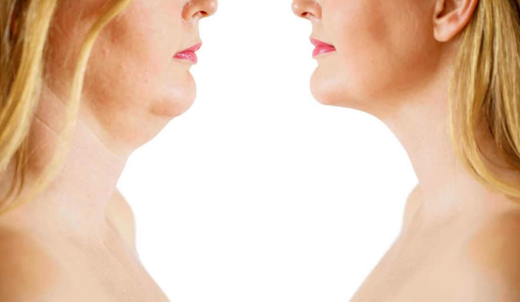 Double Chin treatment Ruislip before and after results
