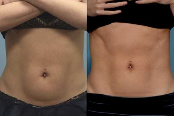 body sculpting FAQs Ruislip