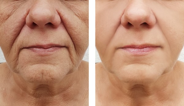 Learn more about Morpheus8 Treatment Ruislip today!