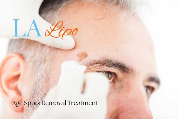 What Are the Most Effective Treatments for Age Spots Ruislip?