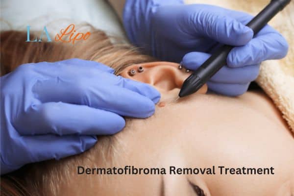 Dermatofibroma Removal Treatment Ruislip