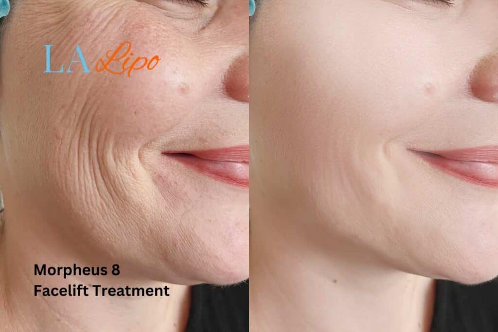 Morpheus8 Treatment Ruislip for flawless skin! Call us today!