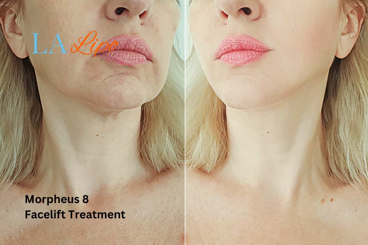 Turn back time with Morpheus8 Treatment Ruislip