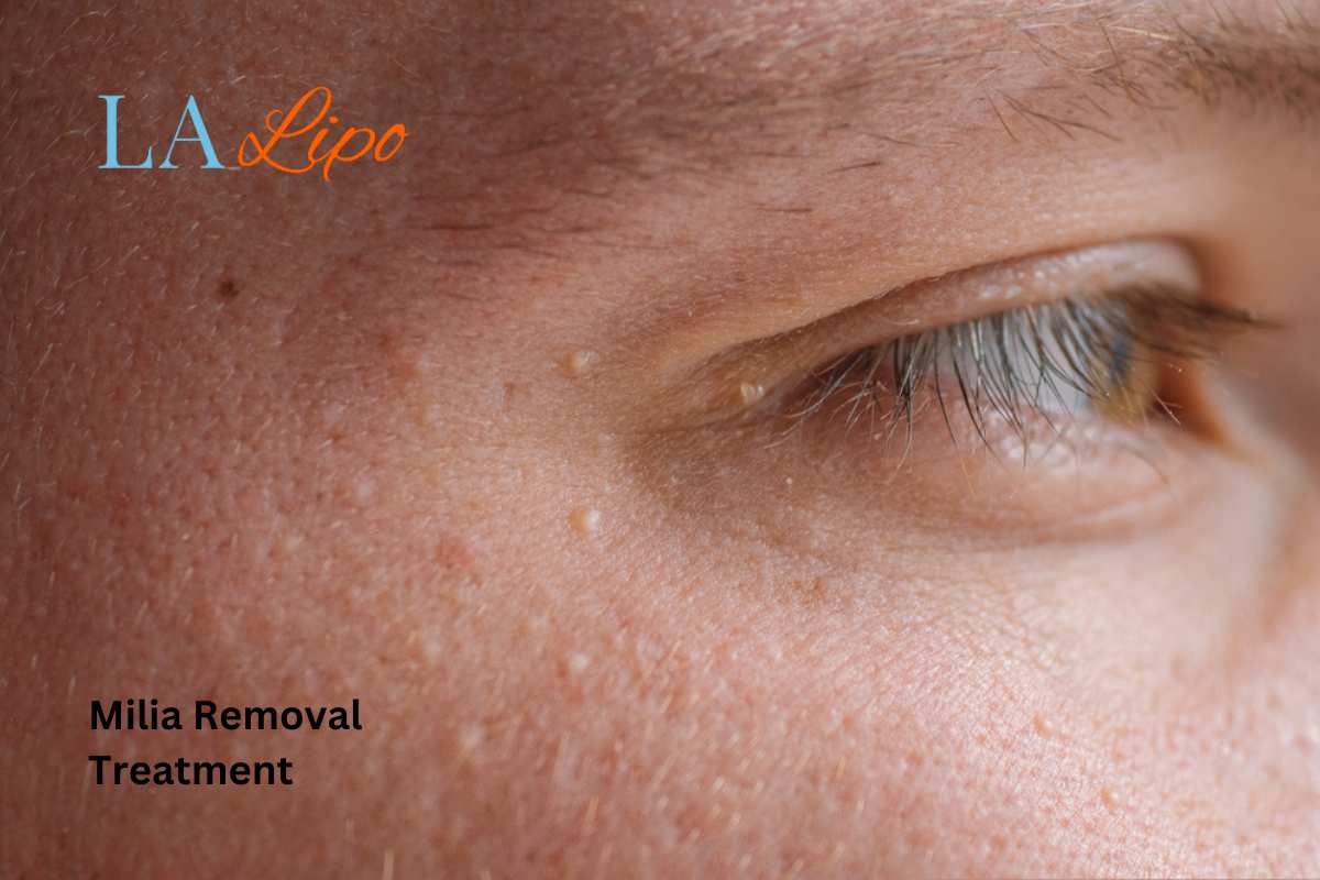 Cryopen Milia Removal: Is It the Easiest and Safest Option Ruislip?