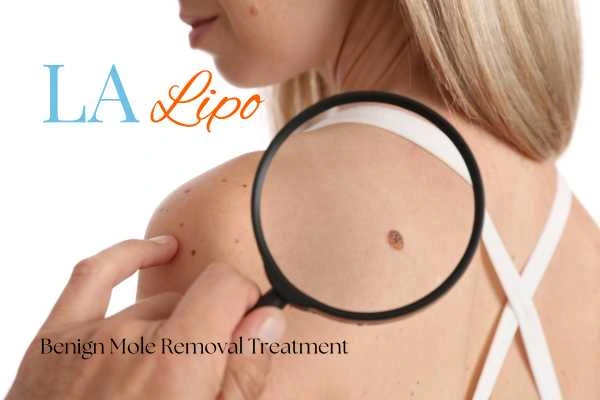 Woman having her inspection of blemish before mole removal Ruislip