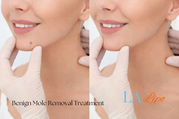 woman's before and after mole removal Ruislip results