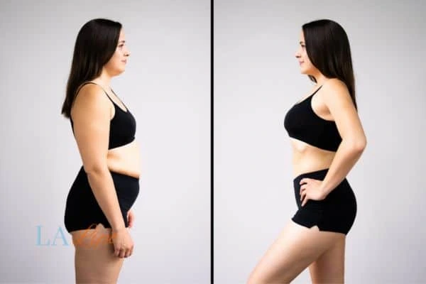 LA-EMS Body Sculpting Ruislip results before and after of womans results on body toning.