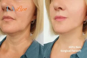 hi-fu for wrinkles Ruislip before and after results