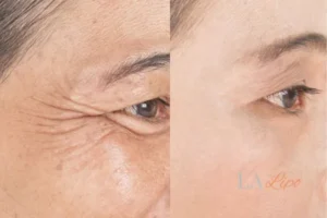 Before and after results of woman - HI-fu wrinkles reduction treatment Ruislip