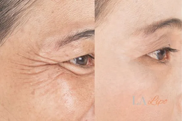 Before and after results of woman - HI-fu wrinkles reduction treatment Ruislip