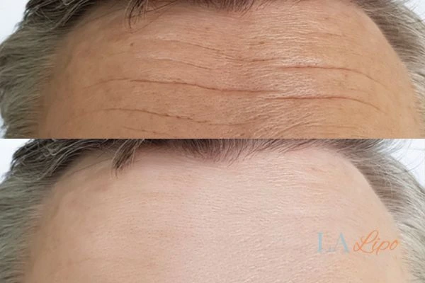 results of HIFU Ruislip on mans forehead to help reduce lines and wrinkles