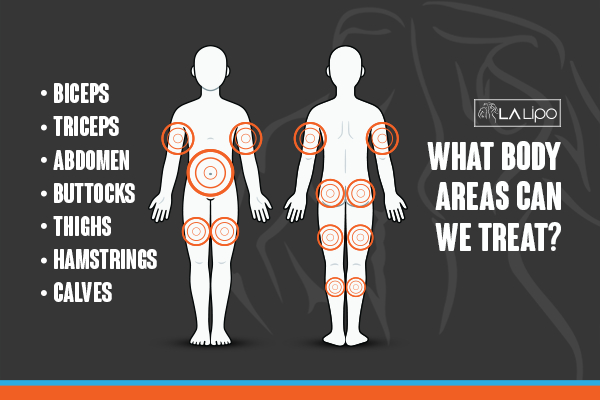 Graphic to show areas you can have LA-EMS Body Sculpting Ruislip treatment.