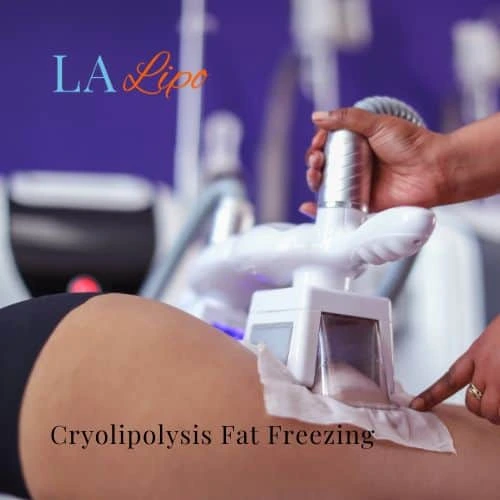 fat freezing - Cryolipolysis Ruislip