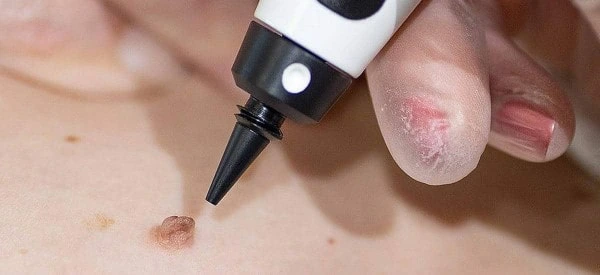 skin tag removal using cryopen Ruislip