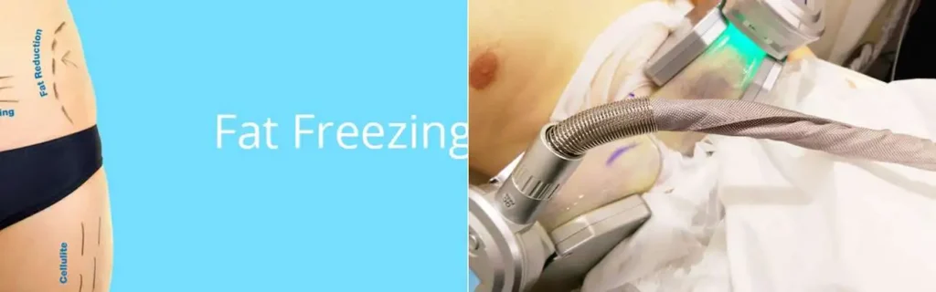 Fat freezing Ruislip on multiple areas of the body