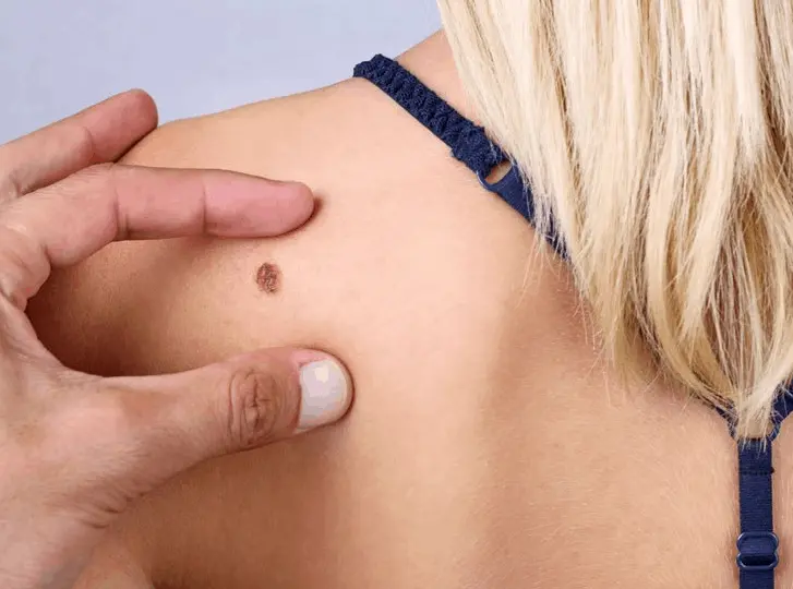 woman having mole removal Ruislip consultation before treatment.