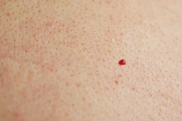 close up of a cherry angioma Ruislip