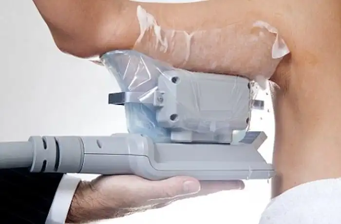 Picture of fat freezing Ruislip on the upper arms.