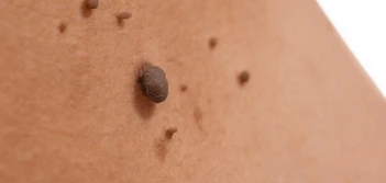 image of a skin tag Ruislip