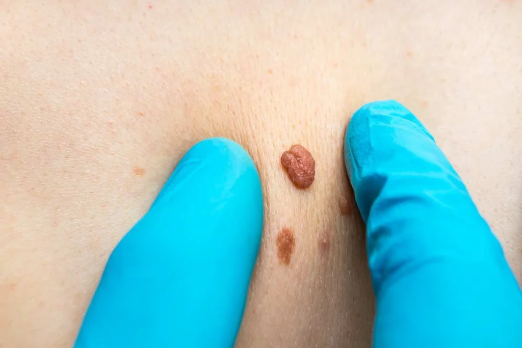 Consultant examining a skin tag Ruislip