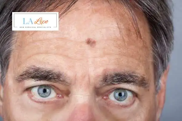 Solar Lentigo Removal Ruislip image of man with mark on his forehead