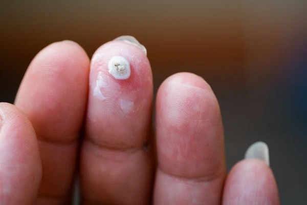 wart on person finger - cryotherapy to treat from LA LIPO Ruislip