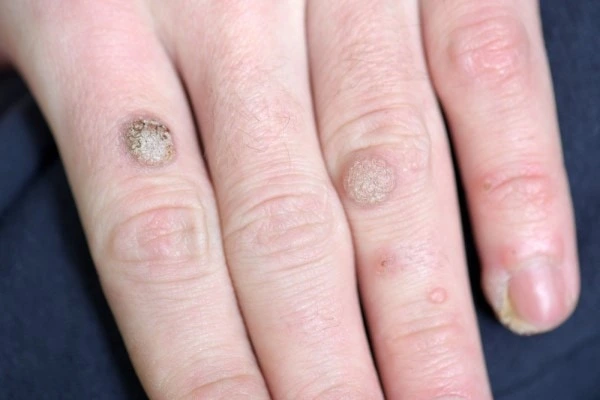 photo of warts on person hand - see wart removal Ruislip from LA LIPO