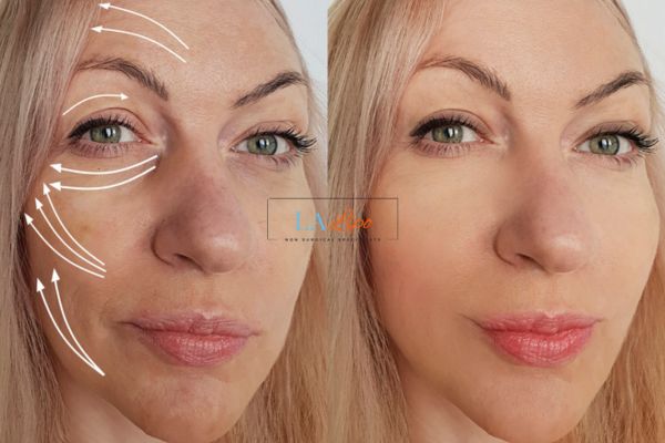 Morpheus 8 results Ruislip face lift.