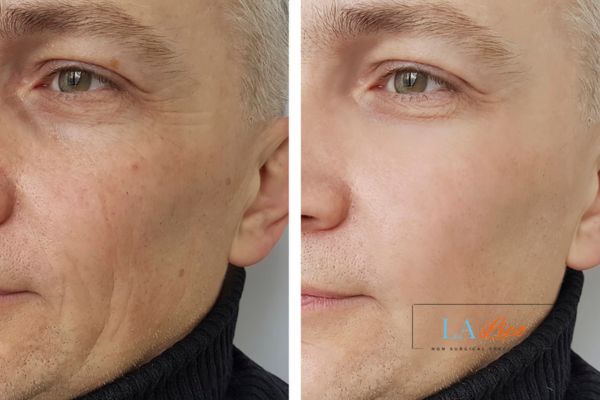 See the amazing results of Morpheus8 Treatment Ruislip!