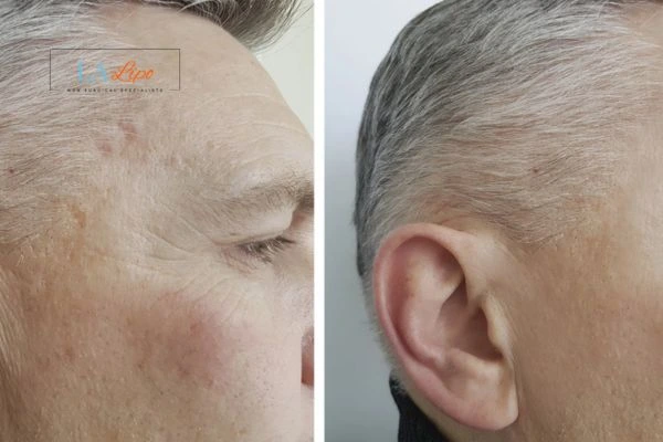 Mens Before & After Morpheus 8 Results Ruislip