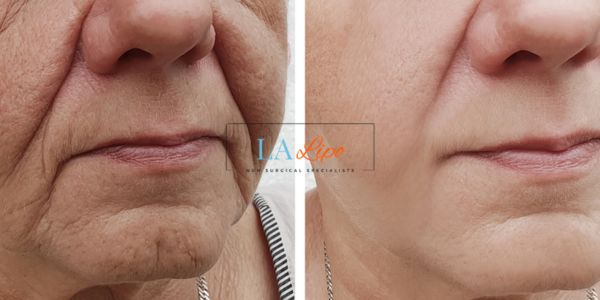 Older lady deeper wrinkle reduction - LA LIPO Morpheus 8 Results Ruislip