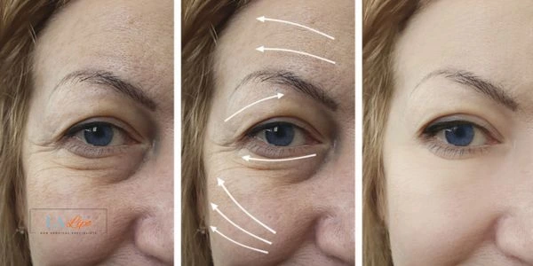 Amazing eye lift Morpheus 8 results Ruislip