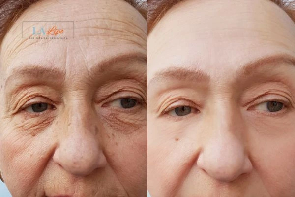 The powerful benefits of Morpheus8 Treatment Ruislip - Call Our team today!
