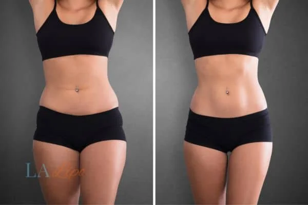 before and after results of non-surgical treatment to help a woman's body image and mental health Ruislip