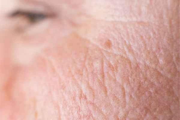 close up picture of a woman's face showing an age spot Ruislip