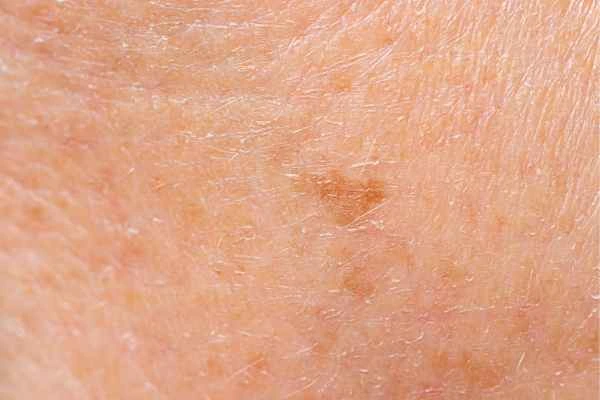close up picture of age spots Ruislip