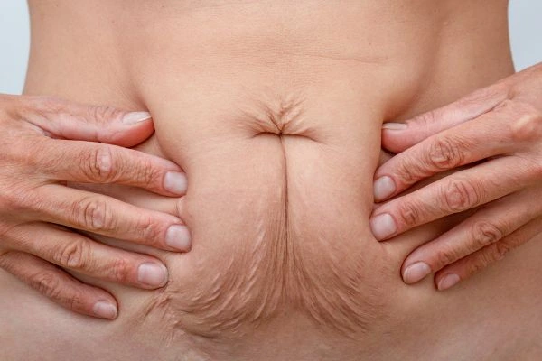 Image of a woman's stomach with loose skin - example of skin tightening Ruislip options