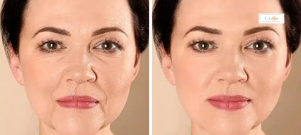 How Long Does It Take to See Results and How Long Do They Last Ruislip?