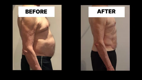 What Symptoms Can Diastasis Recti Cause in Men? Weak Core, Back Pain and Poor Posture Ruislip